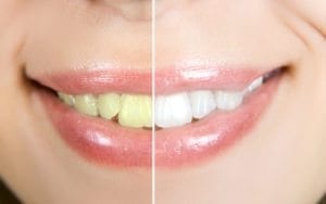cosmetic-dentist-denver-CO-300×188 Cosmetic Dentist Denver CO Before and After