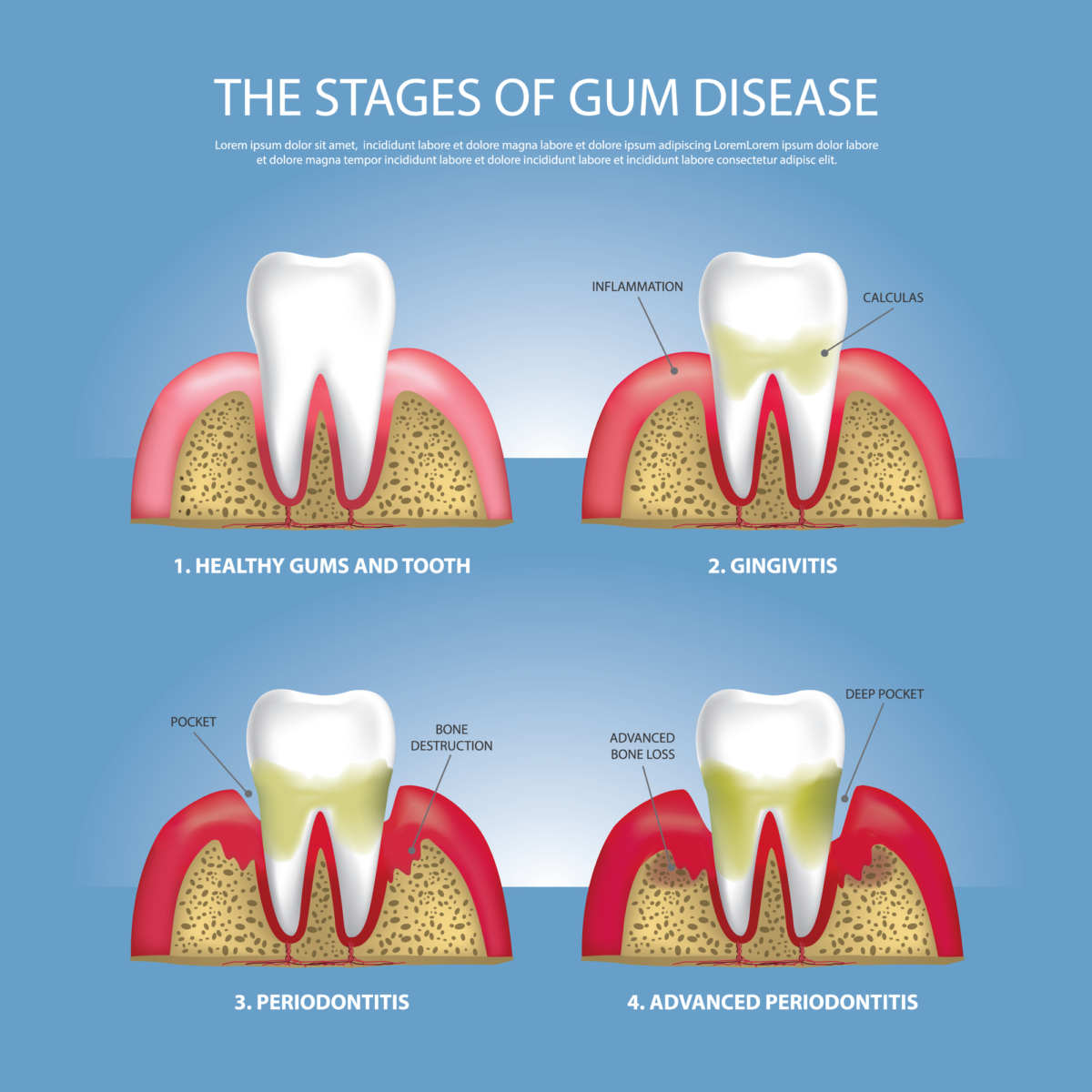How to Stop the Progression of Gum Disease | Dentist ...